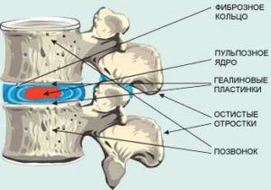 Как лечить протрузию дисков позвоночника поясничного отдела 