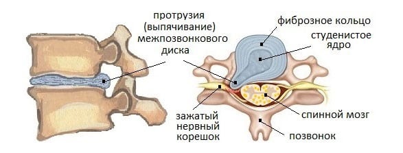 Как лечить протрузию межпозвонковых дисков шейного отдела позвоночника? 