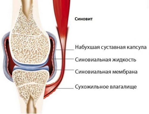 Как лечить синовит коленного сустава в домашних условиях 