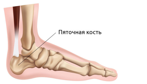 Как лечить такое неприятное заболевание как артроз пяточной кости? 