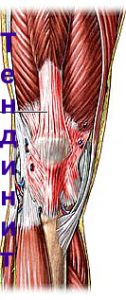 Как лечить тендинит коленного сустава? 