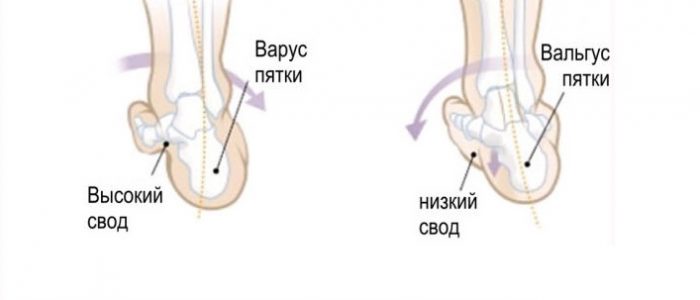 Как лечить варусную деформацию стоп 