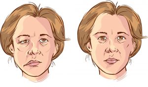 Как лечить защемление лицевого нерва — где он находится, фото до и после медикаментозного лечения неврита 
