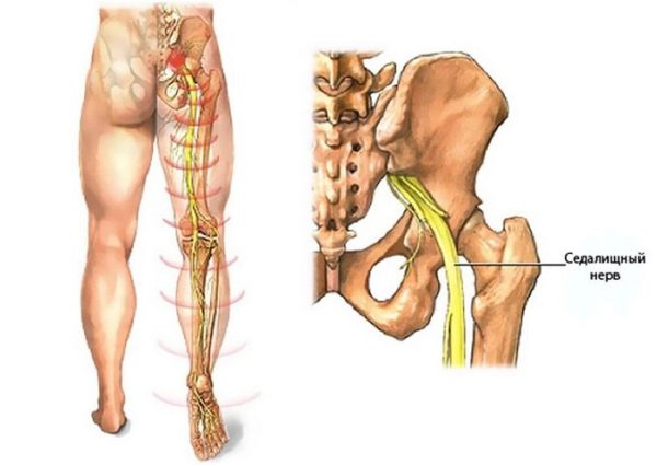 Как лечить защемление седалищного нерва? 