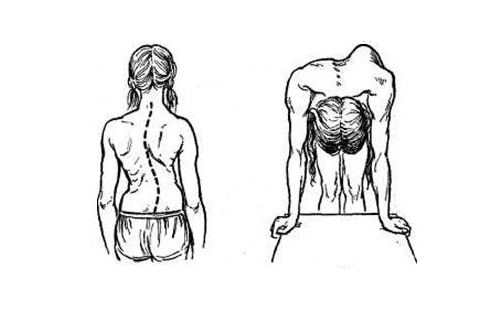Как можно убрать реберный горб при сколиозе? 