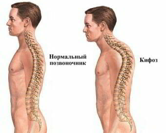 Какой пластырь лучше при остеохондрозе 