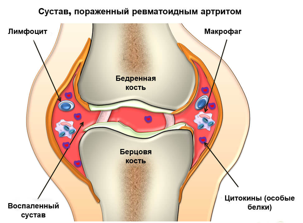 Какой врач лечит артрит — к кому обращаться? 