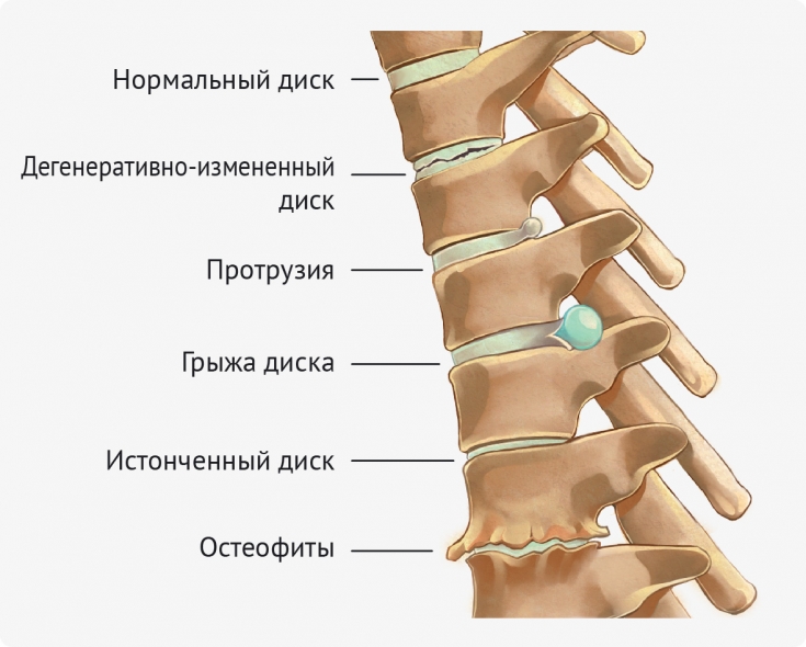 Какой врач лечит протрузию дисков 