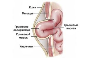 Как определить и лечить кишечную грыжу 