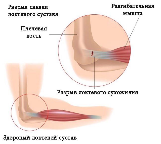 Как определить и лечить растяжение локтевого сустава 