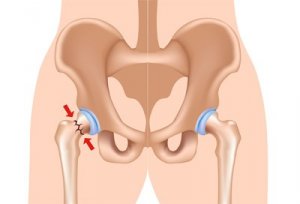 Как определить наличие перелома шейки бедра? 