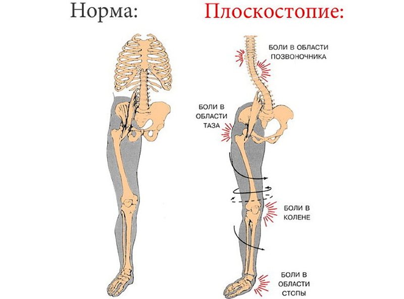 Как определить плоскостопие. Как узнать, что есть плоскостопие 