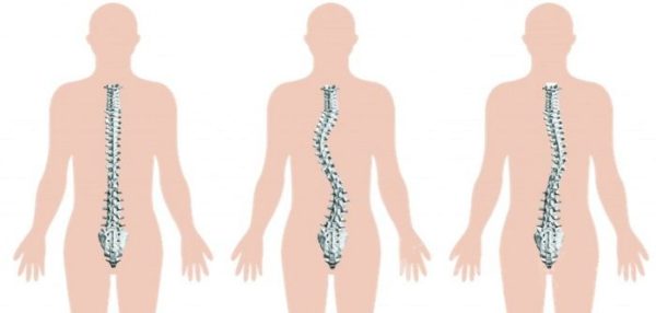 Как определить степень сколиоза 