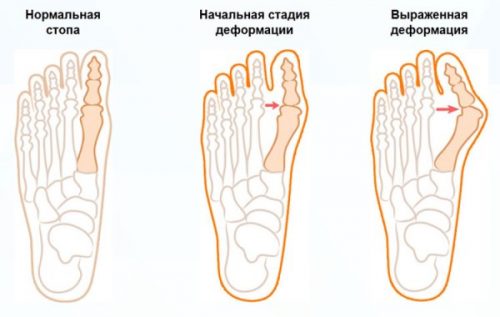 Как остановить рост косточки на ноге возле большого пальца? 