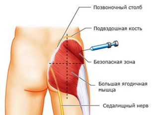 Каковы последствия укола в седалищный нерв 