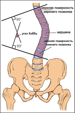 Как правильно определить степень сколиоза 