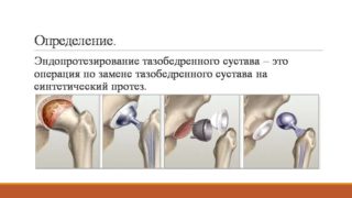 Как правильно выполнять массаж после замены тазобедренного сустава 