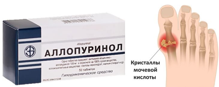 Как принимать Аллопуринол при подагре: показания, противопоказания, дозировка 