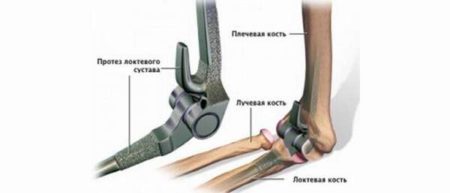 Как проходит эндопротезирование локтевого сустава 