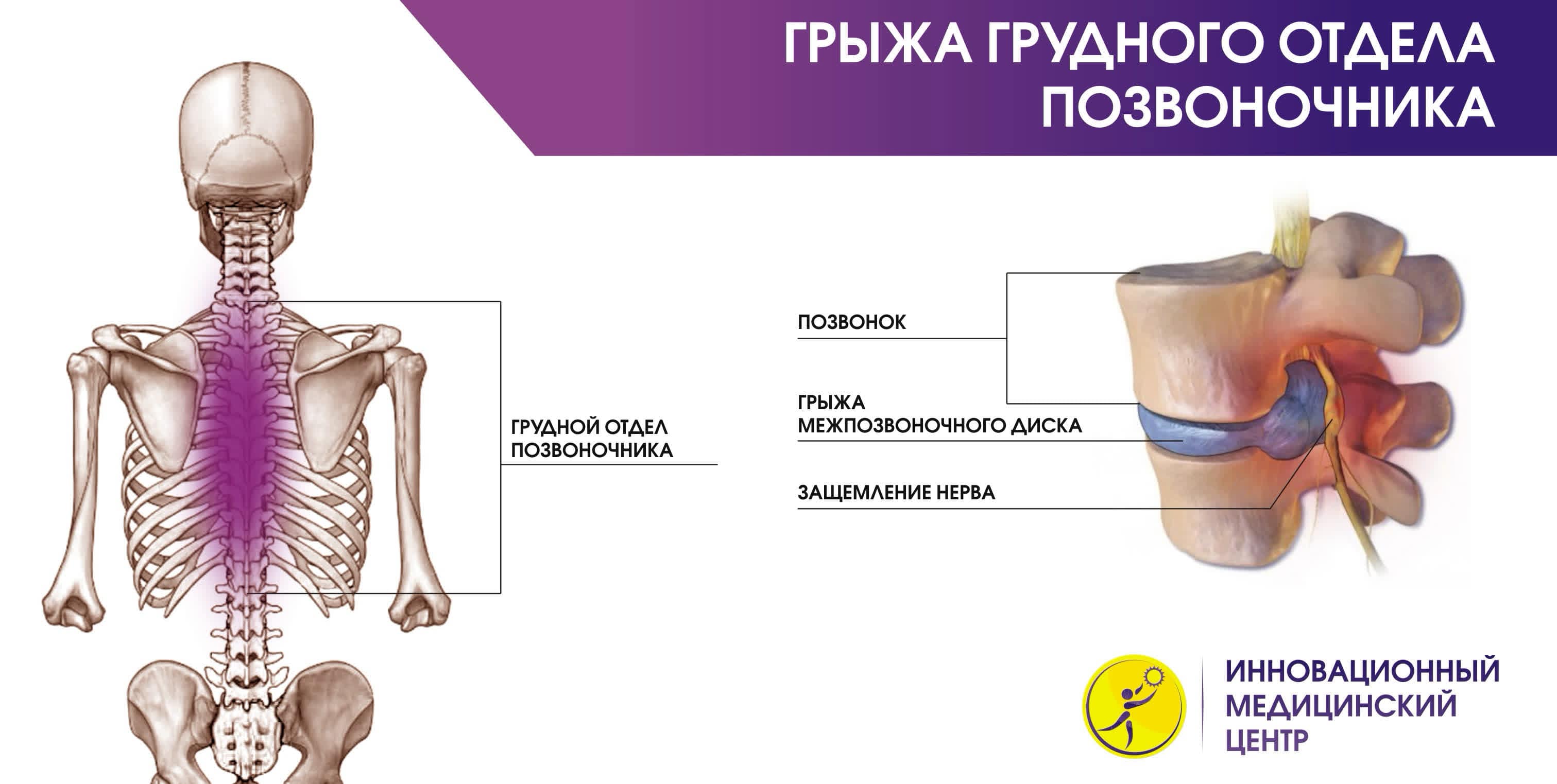 Как происходит и что показывает на снимках МР-томография грудного отдела позвоночника 