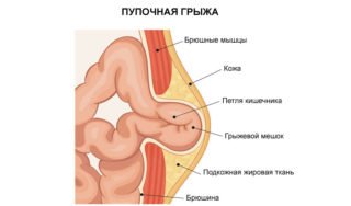 Как проводится операция при пупочной грыже 