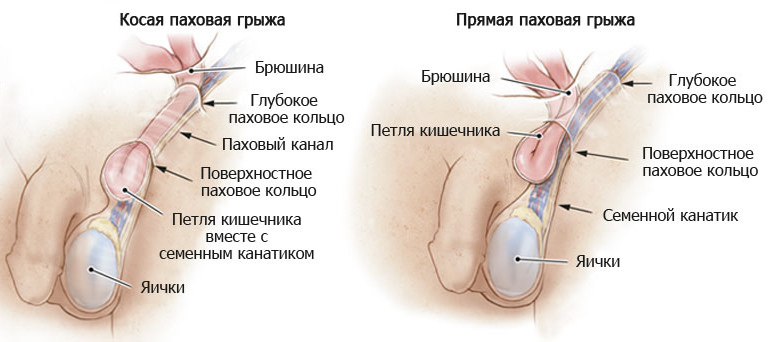 Как проявляется мошоночная грыжа у мужчин и что делать 