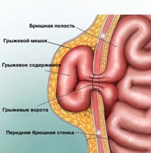 Как распознать грыжу на животе 