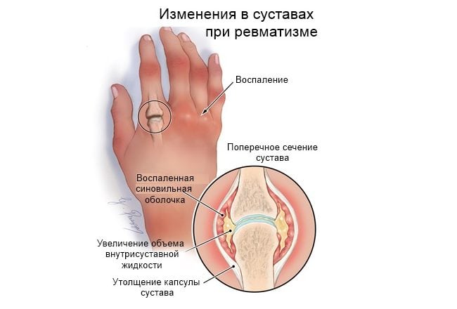 Как распознать и вылечить ревматизм суставов 