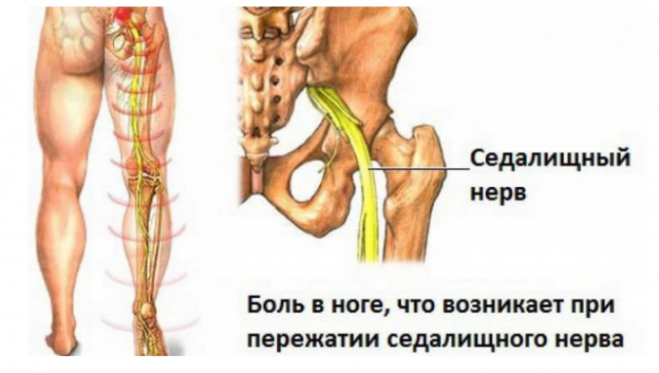 Как разблокировать седалищный нерв 