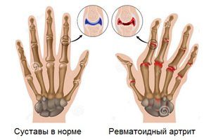 Как сочетаются ревматоидный артрит и алкоголь? 