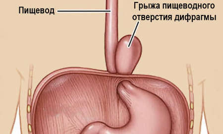 Как удаляют грыжу лапароскопией 8 