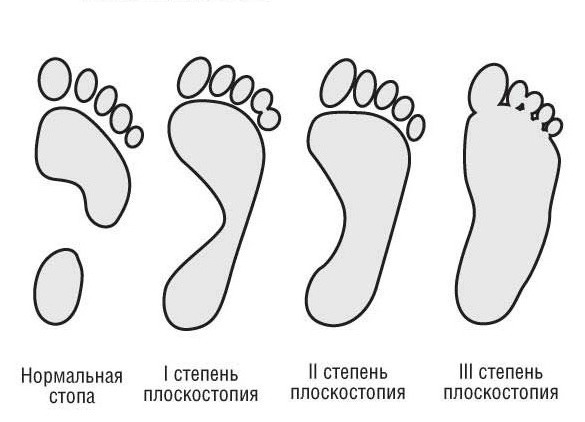 Какую обувь носить при плоскостопии 