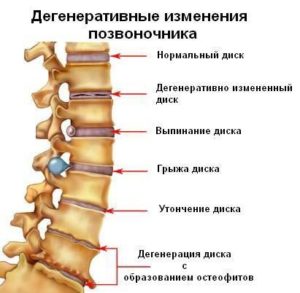 Как узнать какое ДДЗП в шейном отделе 