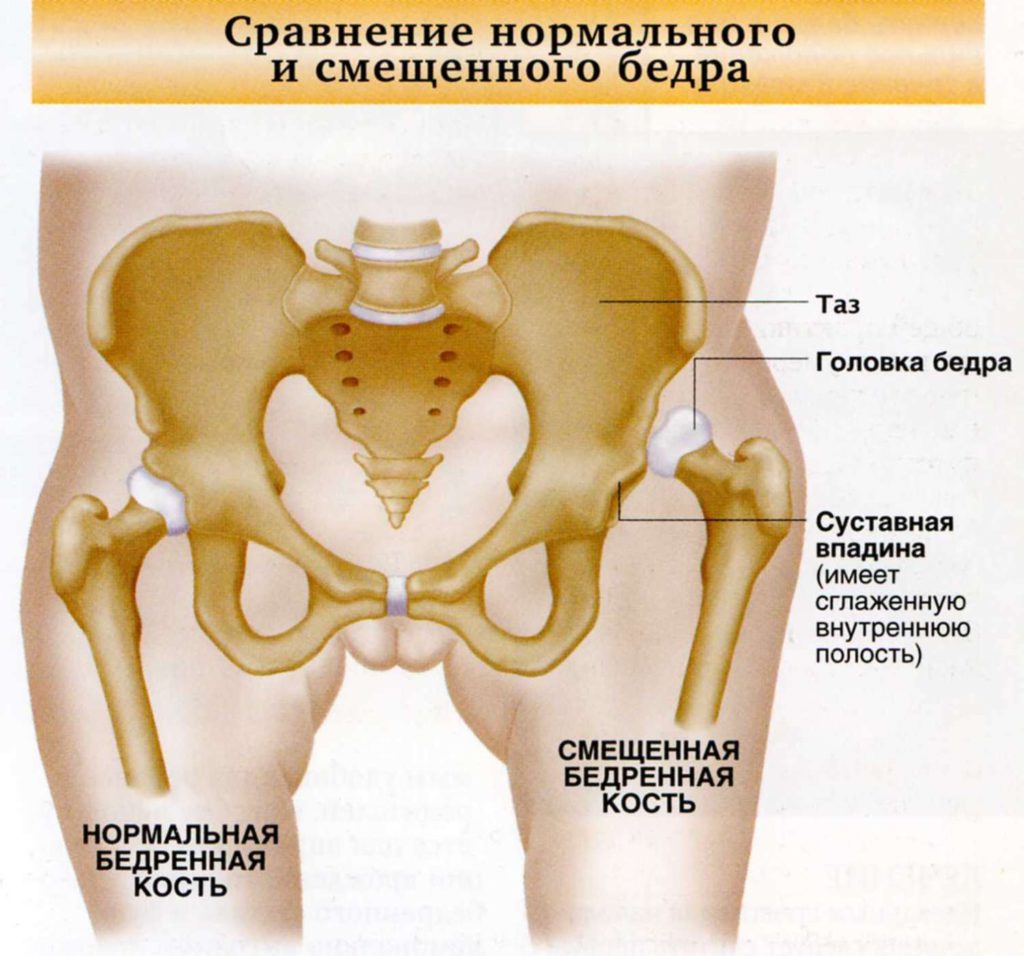 Как вправить тазобедренный сустав 