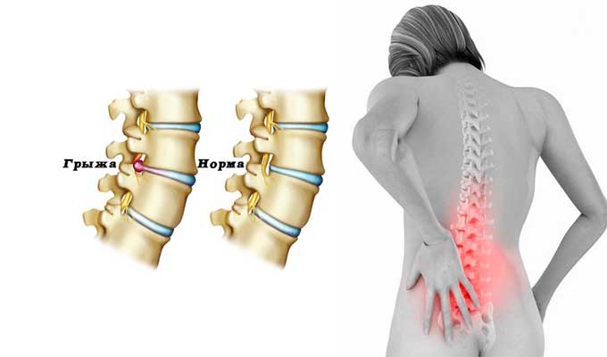 Как выглядит грыжа поясничного отдела позвоночника фото 