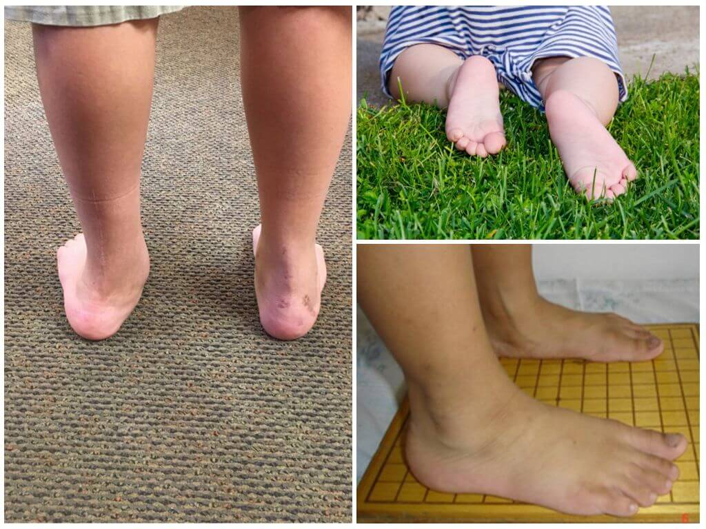 Как выглядит плоскостопие ног: фото и симптомы 
