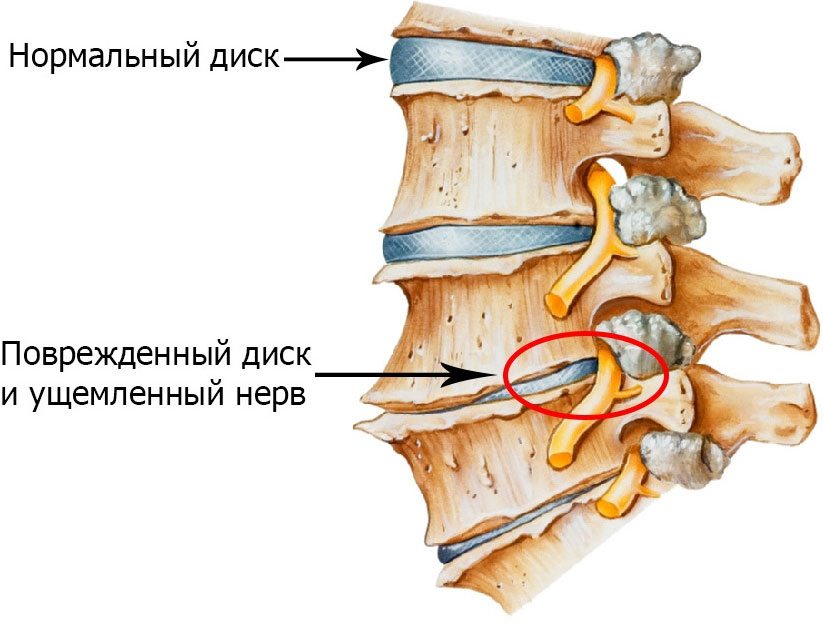 Как вылечить остеохондроз с помощью соли и масла? 