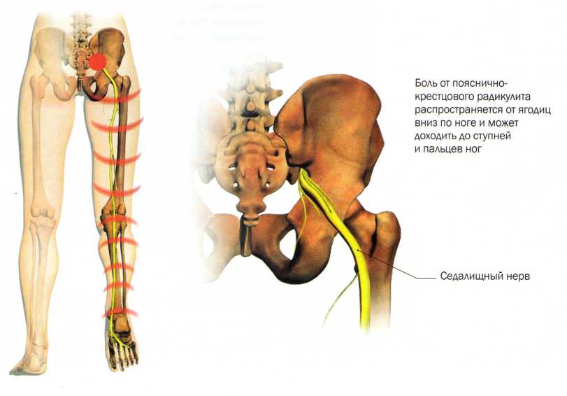 Как вылечить поясничный радикулит? Симптомы и медикаментозное лечение 