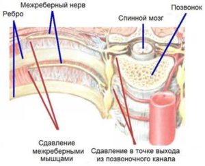 Кодировка межреберной невралгии в МКБ 10 