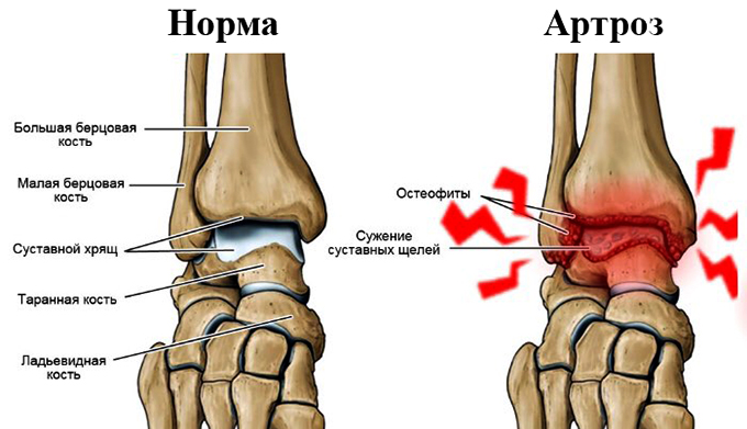 Комплекс упражнений при артрозе голеностопного сустава 