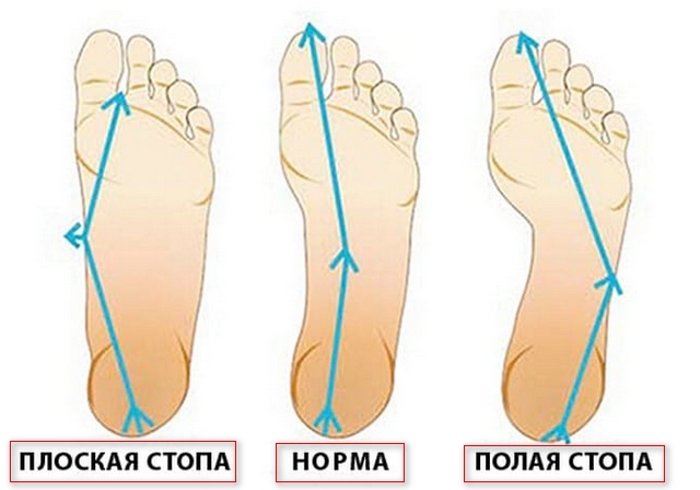 Комплекс упражнений при плоскостопии у взрослых 