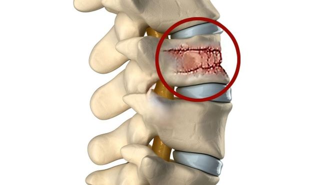 Компрессионный перелом 6 8 позвоночника 