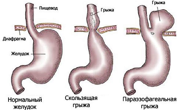 Консервативное лечение грыжи пищевода 