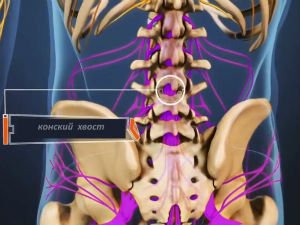 Конский хвост позвоночника 
