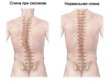 Курсовая работа: Сколиоз 4 