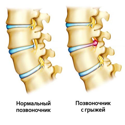 Лечебная физкультура при грыже позвоночника 