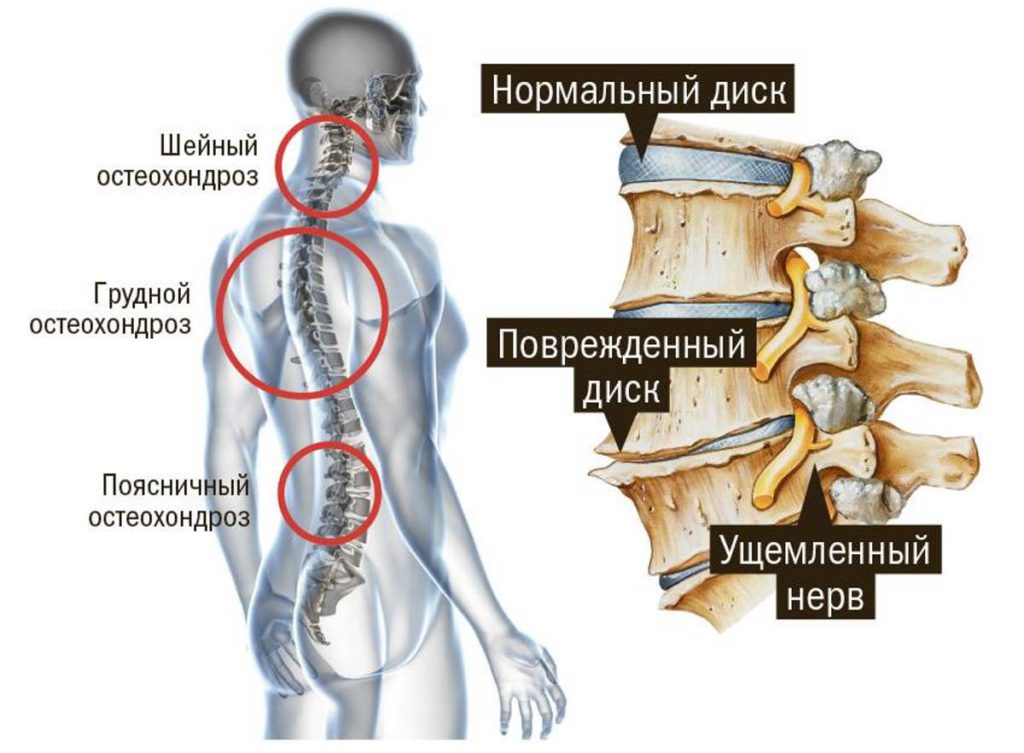 Лечебная физкультура при остеохондрозе грудного отдела позвоночника 