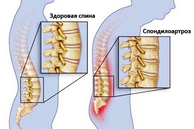 Лечебная физкультура при спондилоартрозе 