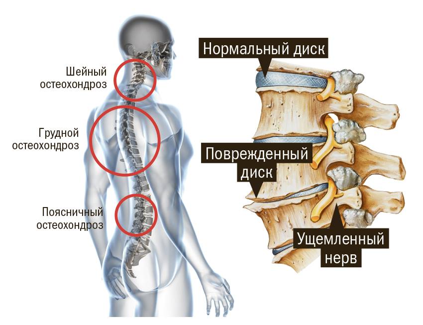Лечебная зарядка при остеохондрозе: шейном, грудном и поясничном 