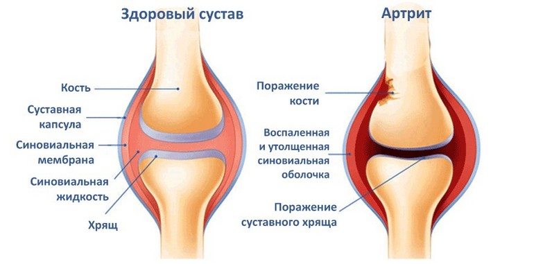 Лечение артрита, симптомы, признаки, причины, полный анализ заболевания 